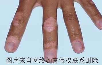 白癜风患者需要注意哪些日常护理