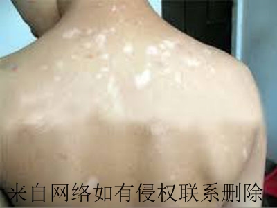 白癜风的治疗费用算出来是多少