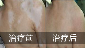 白癜风患者要怎么自查呢