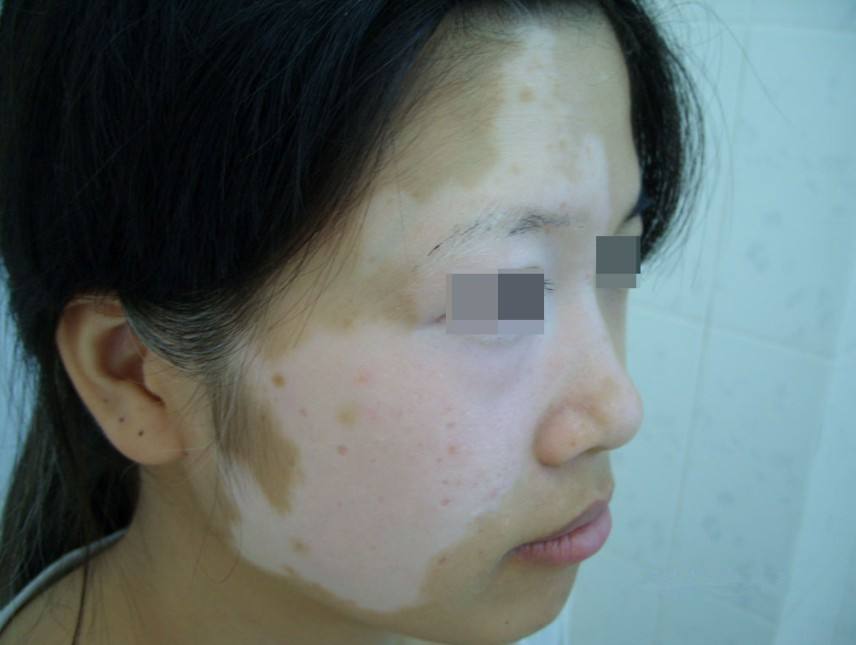 女性白癜风患者诱发的原因有哪些