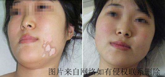 人体免疫力和白癜风有何关系