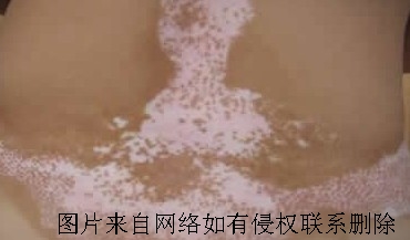 白癜风要怎么有效治疗好