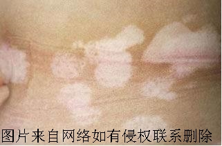 秋季白癜风也是容易发作的么