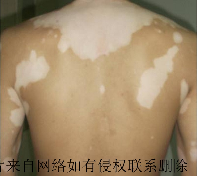 儿童白癜风想要治疗效果好怎么做