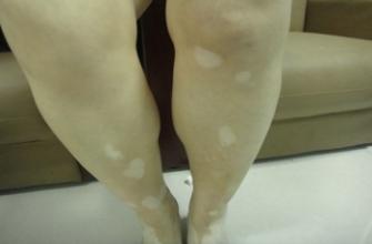 白癜风具体给患者带来哪些危害呢