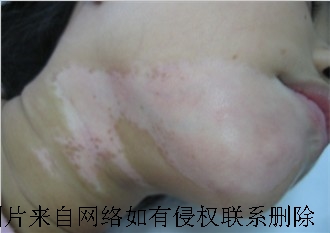 白癜风患上的根本原因是什么