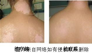 避免白癜风扩散需怎么做