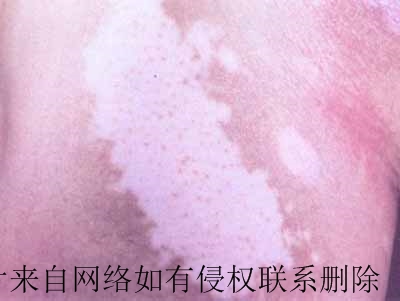 白癜风患者喝饮料注意什么