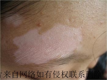 孕妇白癜风患者适合吃哪些食物