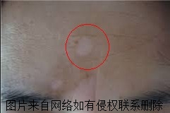 皮肤长白斑要怎么治疗的好