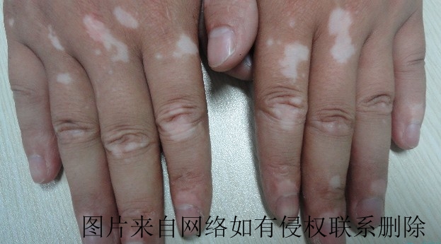 青少年白癜风早期治疗怎么做