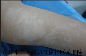 男性患上白癜风有什么原因