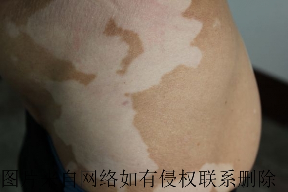 白癜风治疗之前有哪些科学检查的方法