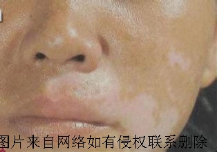 女性白癜风诱发病因有哪些呢