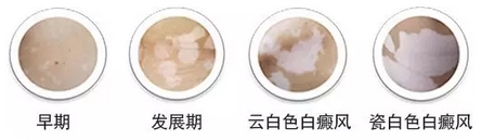 女性面部白癜风有什么症状体现