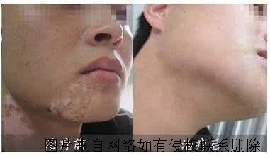 白癜风难治疗是因为什么呢