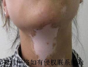 患上白癜风要怎么治疗更好