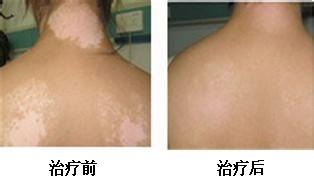 局限性白癜风要怎么治疗好