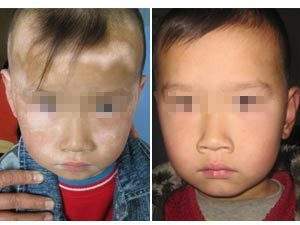 外部导致白癜风发病的原因是什么
