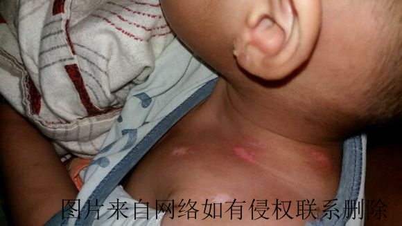 儿童白癜风发病有什么特点